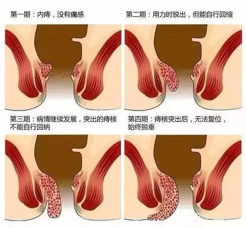 梦见长痔疮预兆 治痔疮最快最好最有效的方法插图