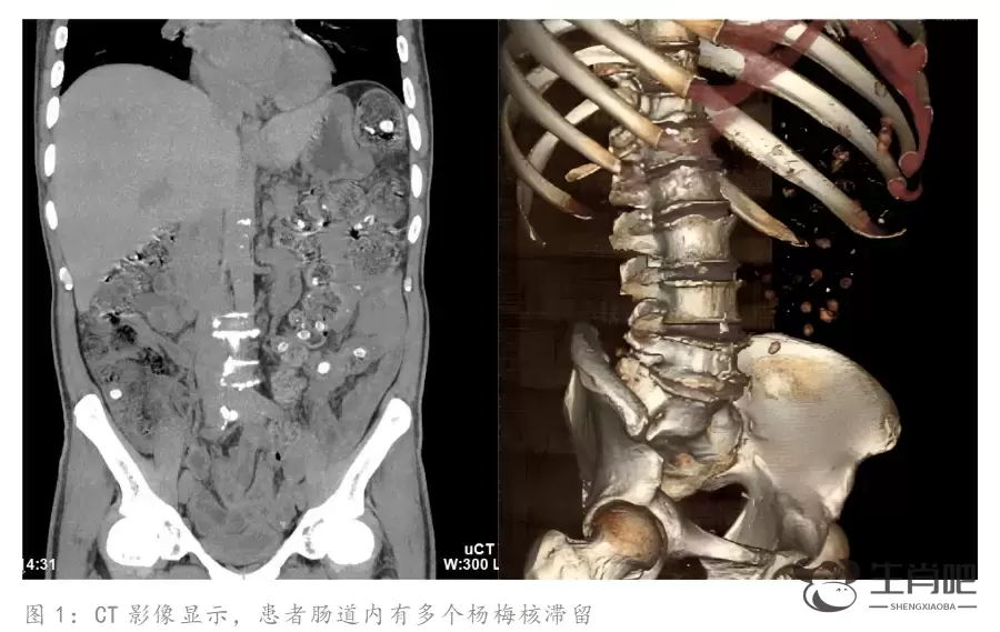 杨梅核咽下肚子能清肠解毒？两名老人因此腹痛难忍进了医院插图