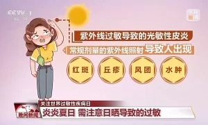 皮肤红肿、瘙痒？你可能“对太阳过敏”！防护指南快查收缩略图